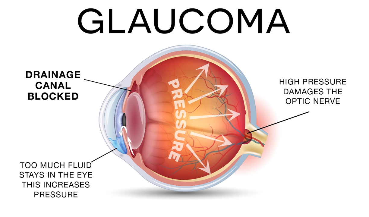 Travoprost and Exercise: Tips for Staying Active with Glaucoma